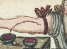 Bloodletting was treatment for infection in the past. Wellcome Library, London, CC BY