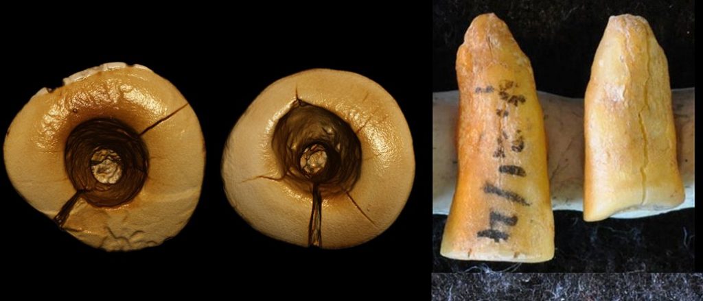 Ancient Dentistry - 13,000-Year-Old Tooth Filling Discovered In Italy