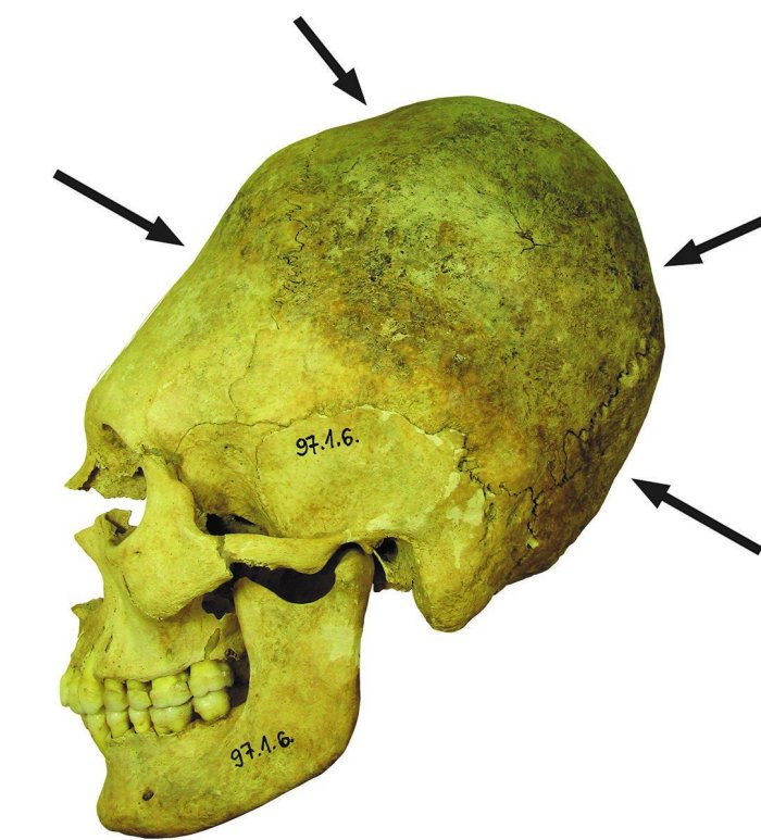 Deformed Skulls And Clues Found In Ancient Cemetery In Hungary