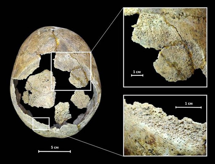 5,000-Year-Old Russian Skull Offers Evidence Of Brain Surgery Made With Stone Scalpel