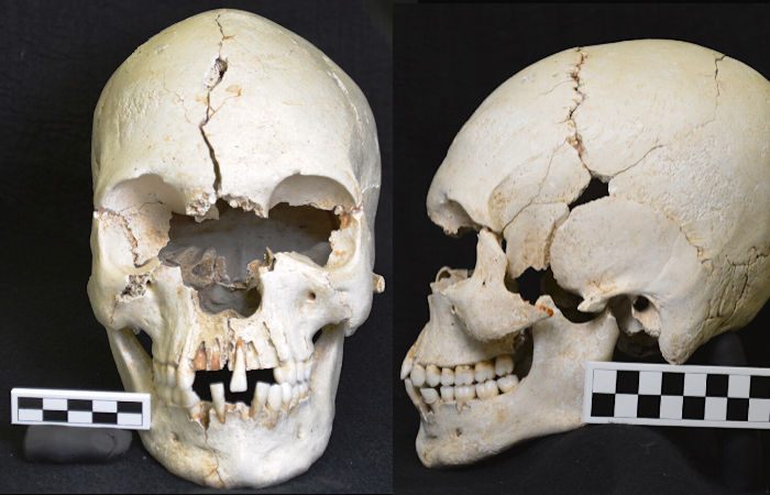 Rare Ancient Caribbean Skull Shows Evidence Of Leprosy