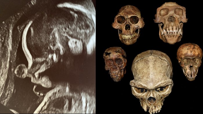 A Surprising Relationship Between The Teeth And The Evolution Of Pregnancy - Study